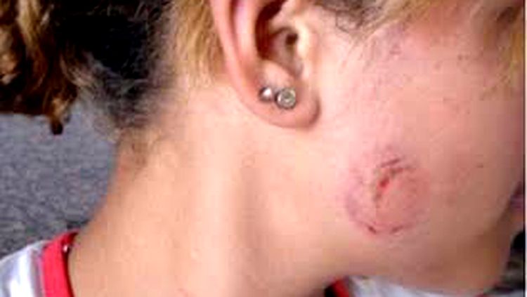 Mulher é agredida pelo ex com mordidas no rosto ao receber mensagem Mulher é agredida pelo ex com mordidas no rosto ao receber mensagem
