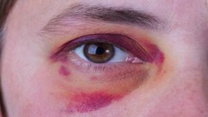Mulher é agredida com vários socos no rosto por amigo enciumado Mulher é agredida com vários socos no rosto por amigo enciumado